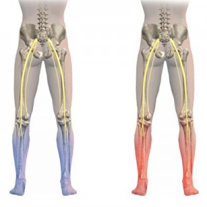 Knee Pain due to Spinal Misalignment